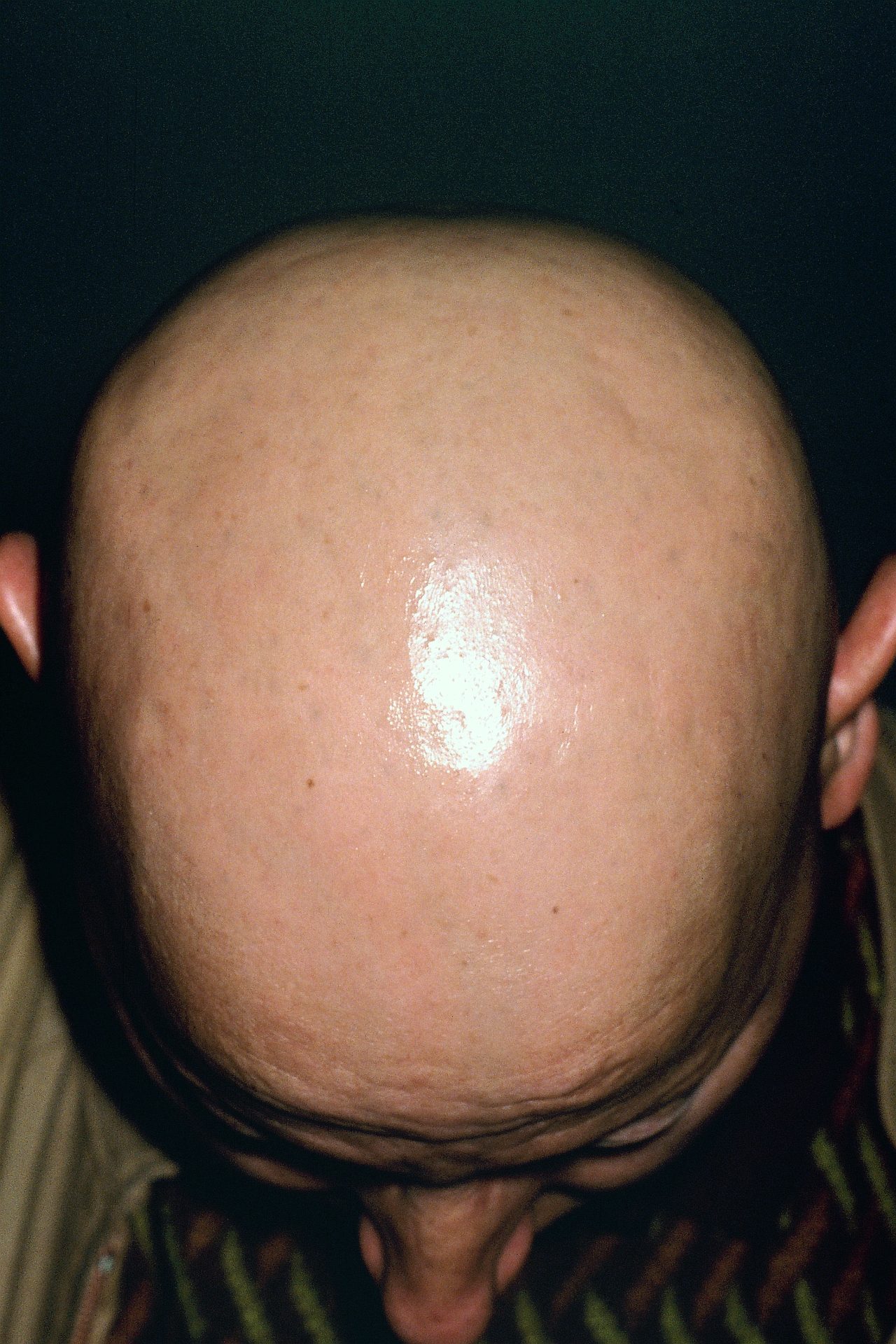 Alopecia